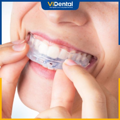Niềng răng bằng hàm đeo trainer khó có thể cải thiện một cách rõ ràng