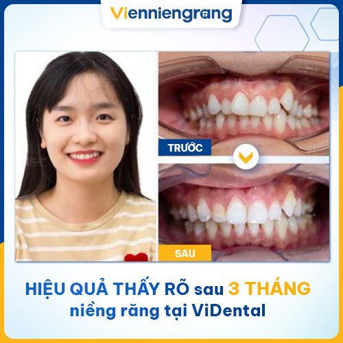 Niềng răng ViDental - Giải quyết triệt để khuyết điểm cung hàm