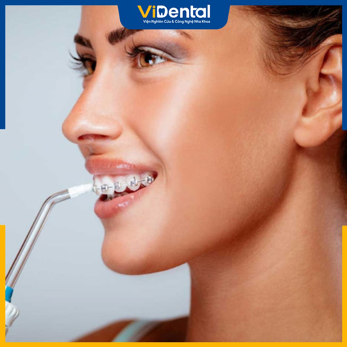 Cần chăm sóc kỹ sức khỏe răng miệng khi niềng răng mắc cài sứ hoặc pha lê