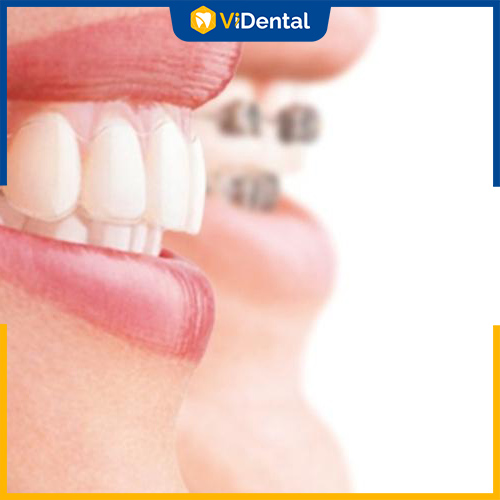 Niềng răng và bọc răng sứ là 2 phương pháp thẩm mỹ răng phổ biến