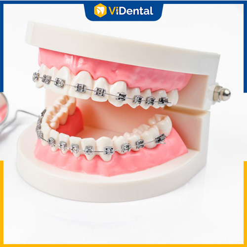 Niềng răng là phương pháp sử dụng hệ thống dây cung, mắc cài