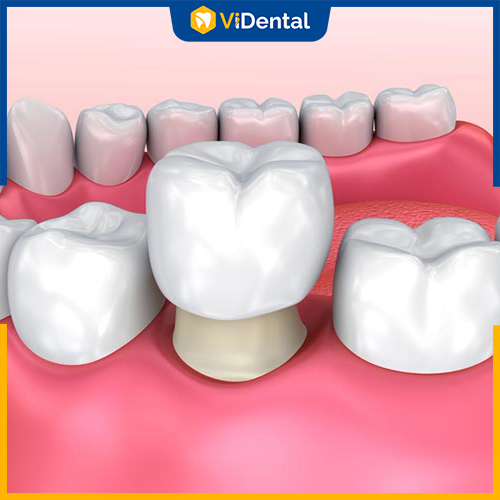 Bọc răng sứ cũng là giải pháp được khách hàng lựa chọn để thẩm mỹ răng
