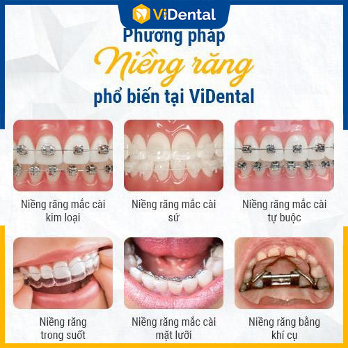 Vidental có đa dạng các phương pháp niềng răng