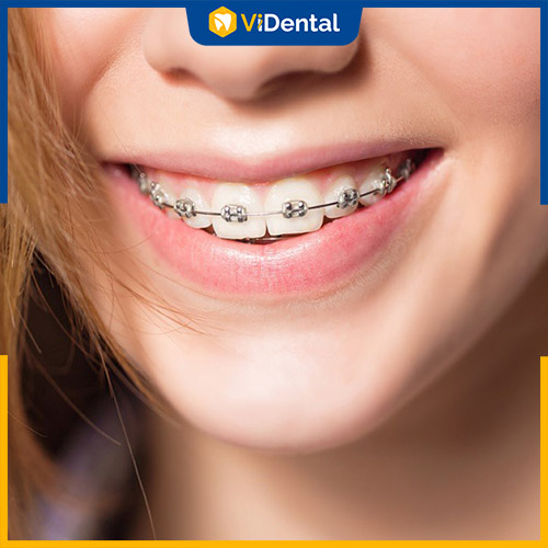 Niềng răng mắc cài kim loại có thể mang đến hiệu quả chỉnh nha tốt