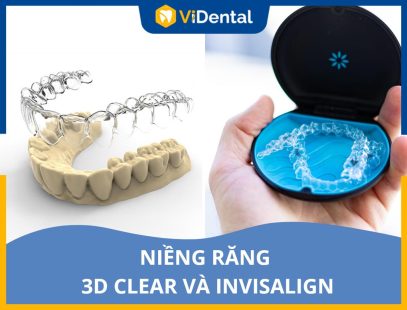 Phân Loại Và Chọn Lựa Giữa Niềng Răng 3D Clear Và Invisalign