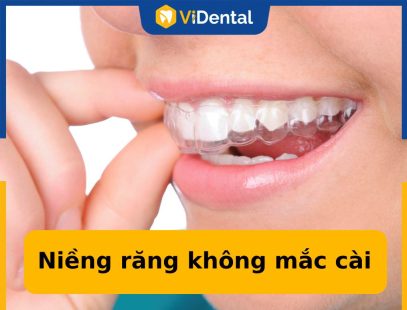 Niềng răng không mắc cài là giải pháp chỉnh nha hiện đại, hiệu quả