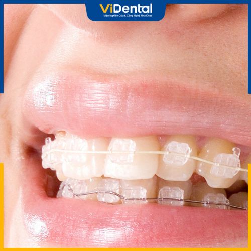 Phương pháp niềng răng pha lê áp dụng được cho nhiều trường hợp