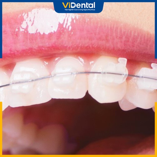 Niềng răng mắc cài sứ có nhiều ưu điểm so với sử dụng mắc cài kim loại