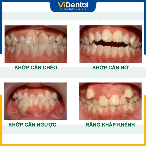 Tình trạng răng miệng khác nhau thì thời gian niềng răng mắc cài sứ khác nhau