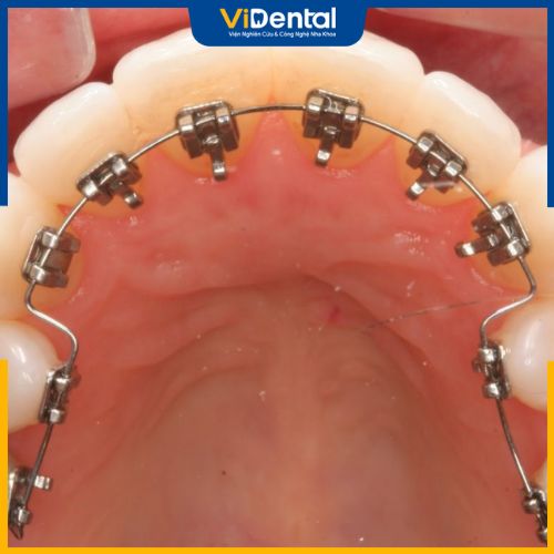 Niềng răng mặt trong hay còn được gọi là chỉnh nha bằng mắc cài mặt lưỡi