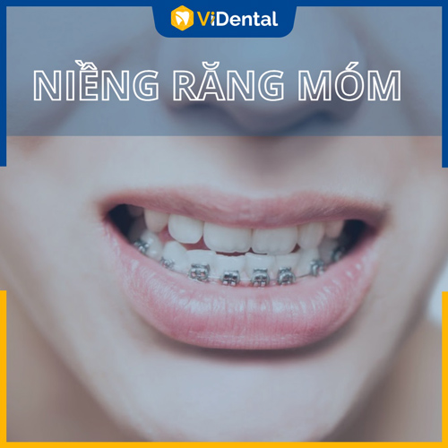 Niềng răng móm trong bao lâu tùy thuộc từng ca bệnh và quy trình cụ thể