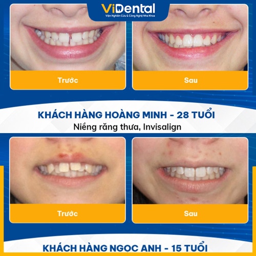 Phản hồi của khách hàng thực hiện niềng răng thành công tại ViDental