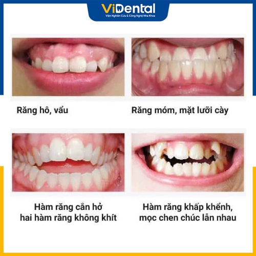 Một số vấn đề răng miệng cần thực hiện niềng răng