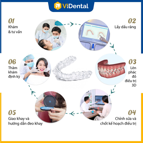 Quy trình các bước cơ bản khi niềng răng trong suốt
