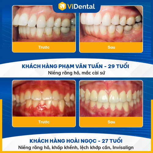 ViDental thành công niềng răng cho nhiều khách hàng trên toàn quốc