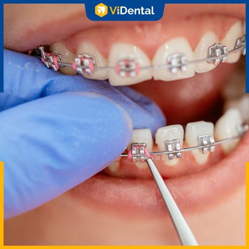 Bác sĩ kém, sai kỹ thuật chỉnh nha dẫn đến răng xê dịch sau khi tháo niềng
