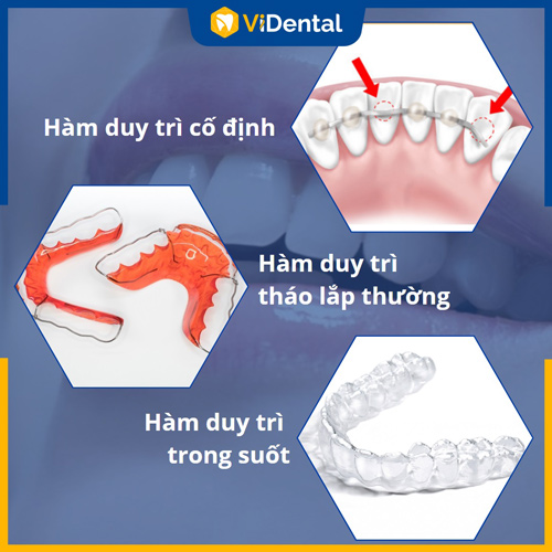 Đeo hàm duy trì là cần thiết để ổn định răng sau khi tháo niềng