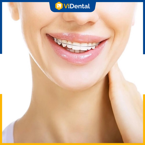 Đeo hàm duy trì, vệ sinh đúng cách ngăn ngừa răng dịch chuyển và biến chứng