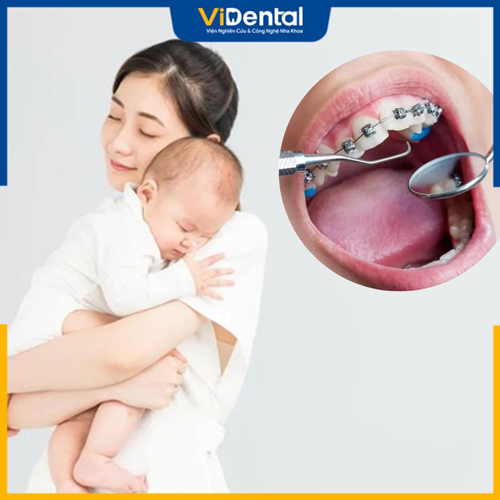 Mẹ sau sinh có thể niềng răng từ tháng thứ 3 sau khi chuyển dạ