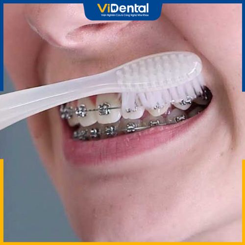 Các bạn nên sử dụng bàn chải lông mềm để đánh răng