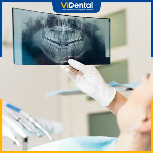 Phí niềng răng phụ thuộc tình trạng răng miệng, độ sai lệch của răng