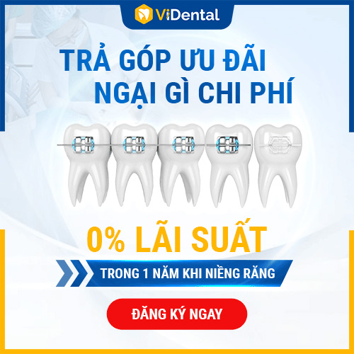 Hết nỗi lo tài chính với niềng răng trả góp 0% tại Vidental