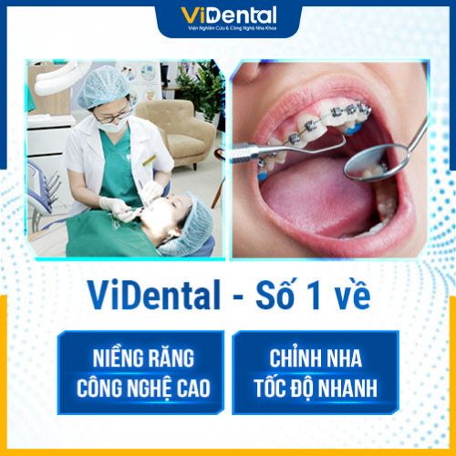 Niềng răng giá tốt ở đâu - Đừng bỏ qua ViDental