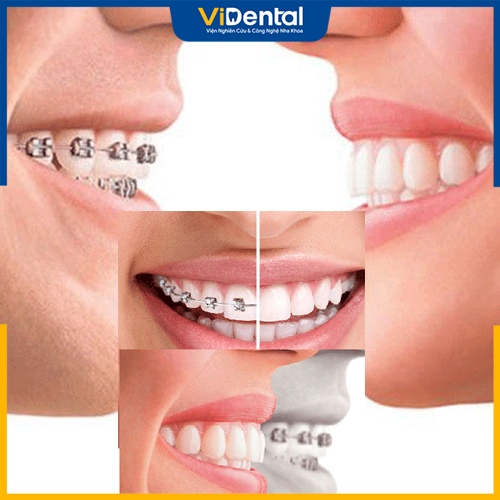 Tùy vào từng tình trạng bác sĩ sẽ cho phép có được niềng răng sau khi bọc sứ hay không
