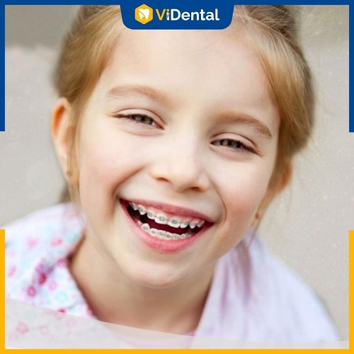 Trẻ em niềng răng thông thường sẽ không cần nhổ răng