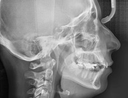 Để đưa ra phương án niềng răng bắt buộc phải phân tích xương, cung hàm, xoang và các bộ phận liên quan