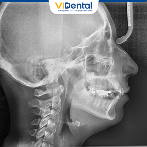 Để đưa ra phương án niềng răng bắt buộc phải phân tích xương, cung hàm, xoang và các bộ phận liên quan