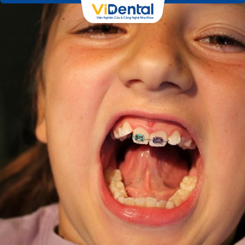 Sử dụng niềng răng mắc cài với đối tượng trẻ bị lệch răng cửa là tối ưu nhất