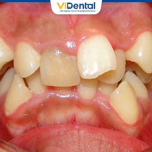 Răng mọc lệch dễ gây ra tình trạng viêm nhiễm do khó vệ sinh
