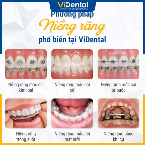 ViDental Brace cung cấp đa dạng gói dịch vụ niềng răng
