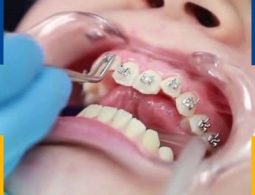 Kỹ thuật niềng răng quyết định rất nhiều đến hiệu quả sau cùng