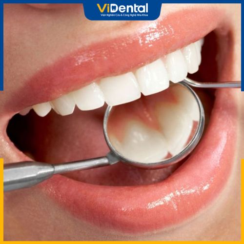 Các bạn cân chú ý chăm sóc răng miệng trong và sau quá trình niềng răng