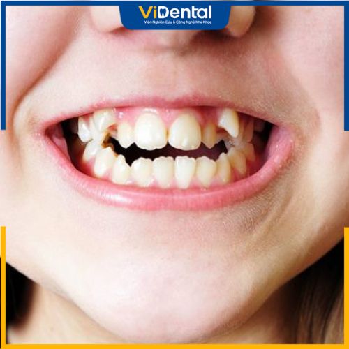 Răng khấp khểnh là tình trạng các răng mọc sai lệch vị trí và hướng mọc