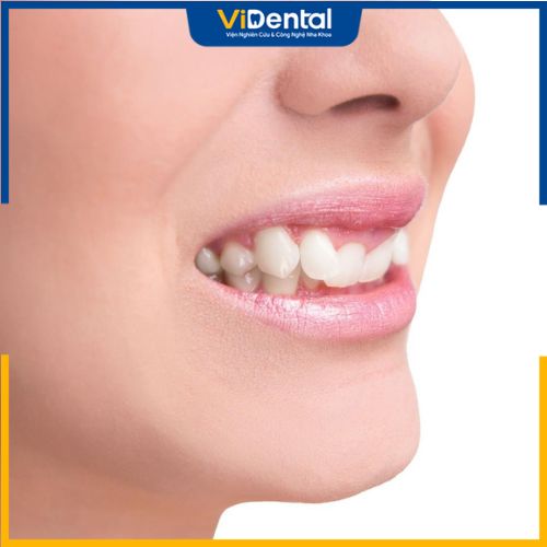 Theo nhân tướng học, những người có răng khểnh thường khá hoạt bát