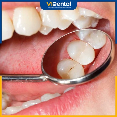 Kiểm tra tình trạng răng miệng là khâu quan trọng trước khi niềng răng
