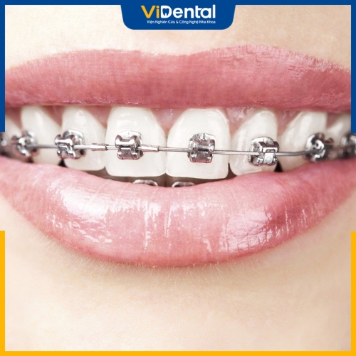 Niềng răng mắc cài là phương pháp chỉnh nha phổ biến hiện nay 