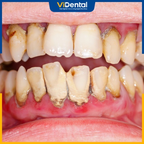 Trong trường hợp viêm nha chu nặng cần điều trị dứt điểm trước khi niềng răng