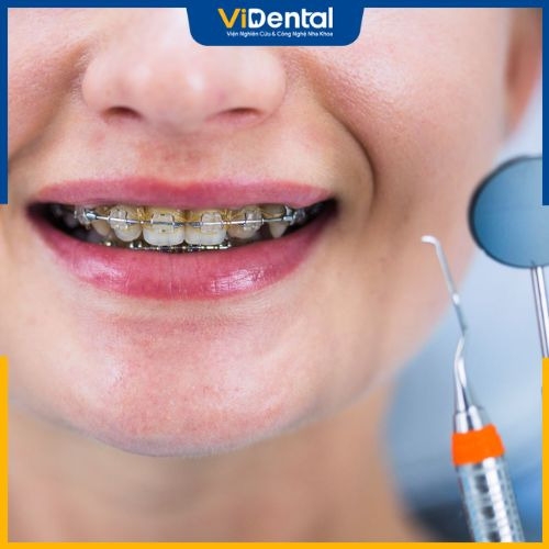 Phương pháp niềng răng mắc cài kim loại phổ biến hiện nay