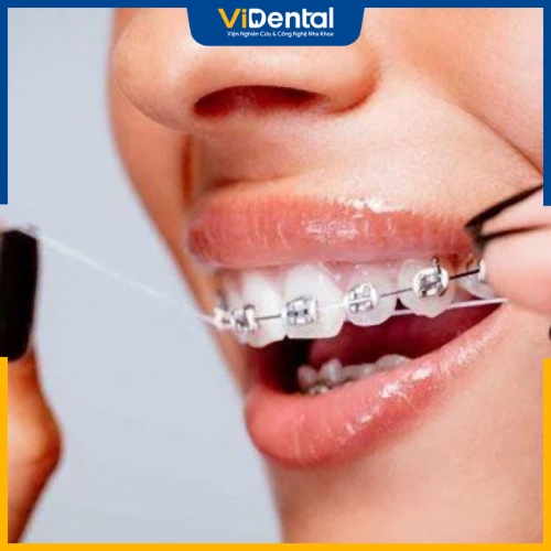 Nên tháo thun liên hàm để vệ sinh và chăm sóc răng miệng dễ dàng hơn 