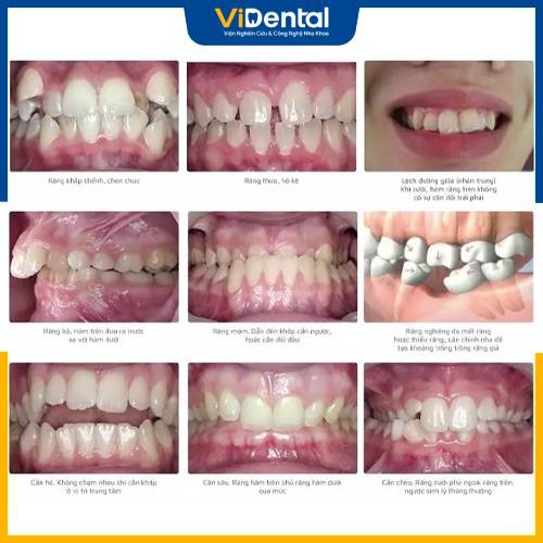 Lựa chọn phương pháp cần phụ thuộc vào tình trạng răng của người bệnh