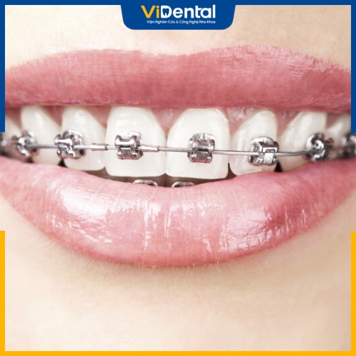 Trong trường hợp sức khỏe răng ổn định thì không cần nhổ răng khôn