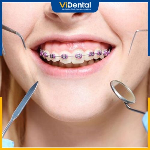 Các bác sĩ sẽ tiến hành nhổ răng khôn mọc trong quá trình niềng răng 