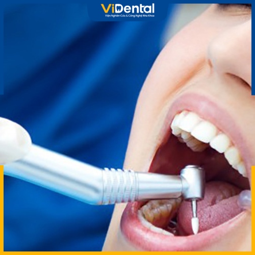 Nhổ răng có thể cần thiết khi chỉnh nha để tăng hiệu quả điều trị