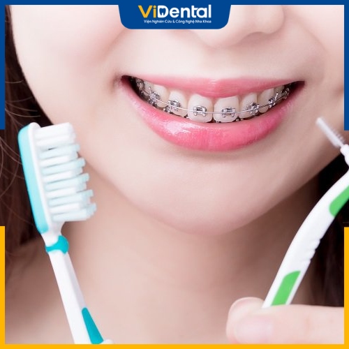 Có kế hoạch chăm sóc răng miệng trong quá trình niềng răng giữ răng khểnh 