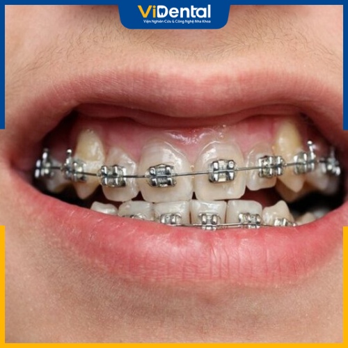 Các chuyên gia khuyến cáo nên niềng răng khểnh để đảm bảo tính thẩm mỹ 