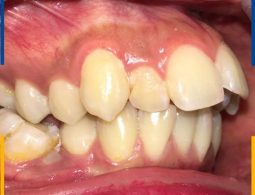 Thông thường các trường hợp răng hô nặng đều do di truyền